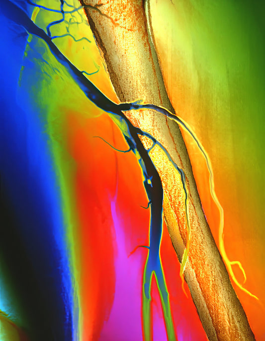 Image of Blood Clot in Arm | Fine Art Print | TotalUSAMagazine