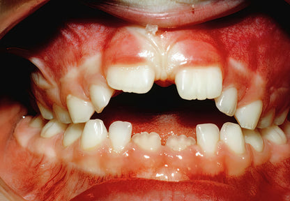 Teeth from Thumb-sucking: 19th Century Dental Illustration | TotalUSAMagazine
